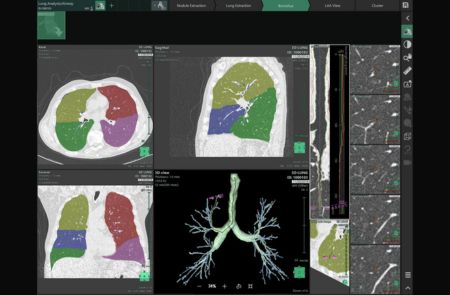 3D-technologie ondersteunt bij longkanker